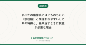 まぶたの脂腺癌とは？ものもらい（霰粒腫）と間違われやすいしこりの特徴と、繰り返すときに検査が必要な理由