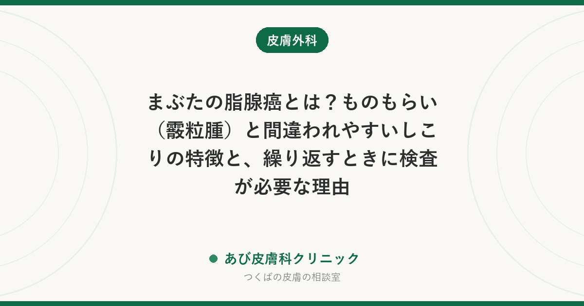まぶたの脂腺癌とは？ものもらい（霰粒腫）と間違われやすいしこりの特徴と、繰り返すときに検査が必要な理由