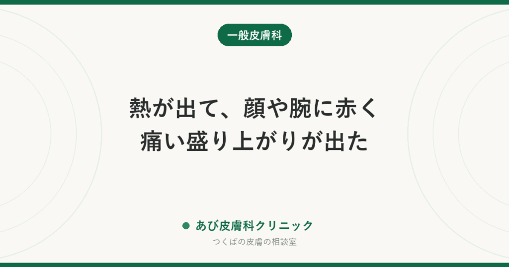 熱が出て、顔や腕に赤く痛い盛り上がりが出た｜スウィート病（急性熱性好中球性皮膚症）とは？見分け方と受診の目安