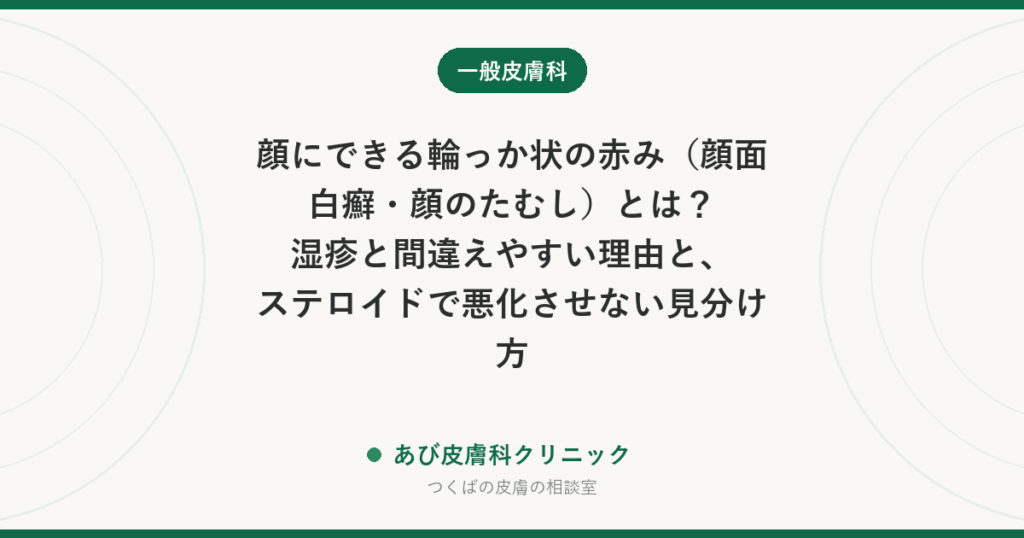 顔にできる輪っか状の赤み（顔面白癬・顔のたむし）とは？湿疹と間違えやすい理由と、ステロイドで悪化させない見分け方