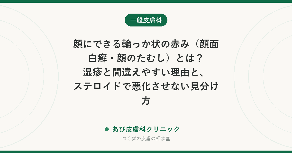 顔にできる輪っか状の赤み（顔面白癬・顔のたむし）とは？湿疹と間違えやすい理由と、ステロイドで悪化させない見分け方