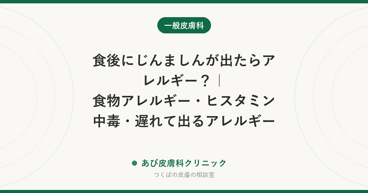 食後にじんましんが出たらアレルギー？ 食物アレルギー・ヒスタミン中毒・遅れて出るアレルギーの解説記事アイキャッチ